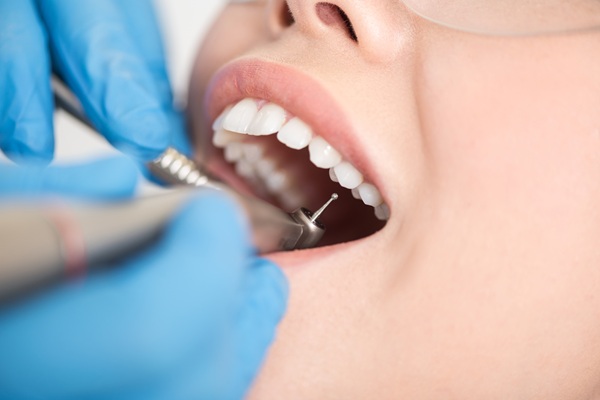 Understanding The Dental Filling Process