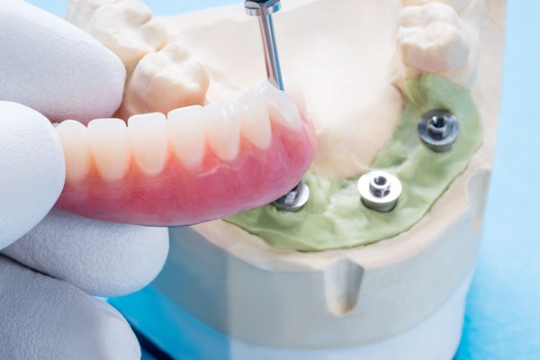 Benefits Of Implant Supported Dentures