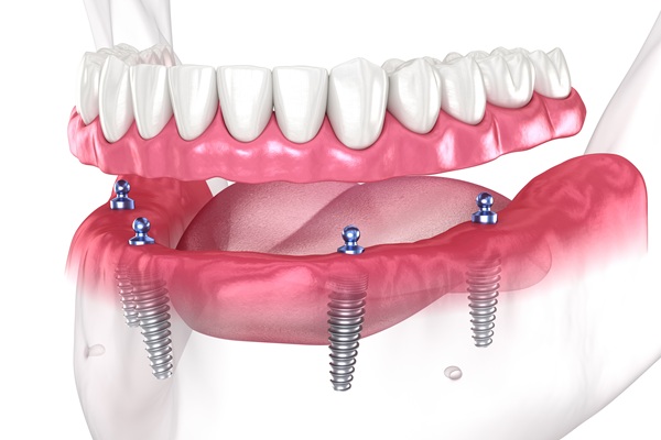 Bring Back A Stronger Smile With Implant Supported Dentures