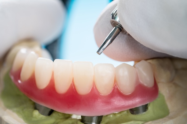 Implant Supported Dentures Guide: Process, Benefits, And Care